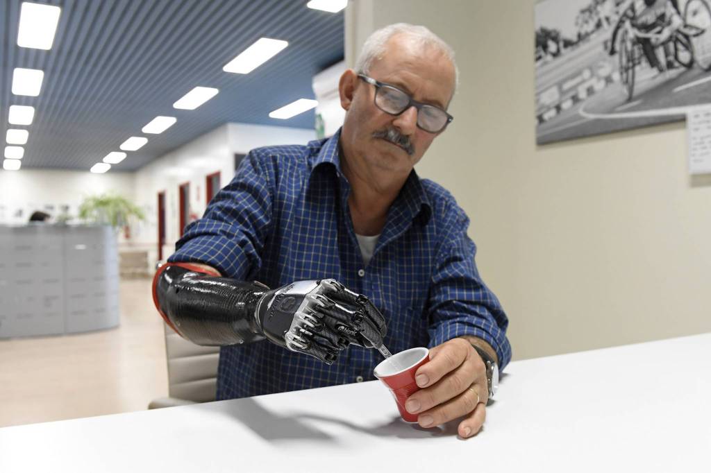 Applicata una mano “bionica” ad un artigiano di Mondovì